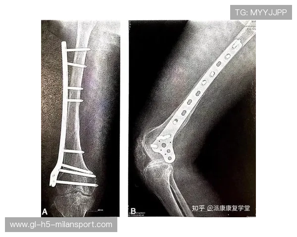 羽毛球运动员手指受伤：从弯曲到康复的全面指南